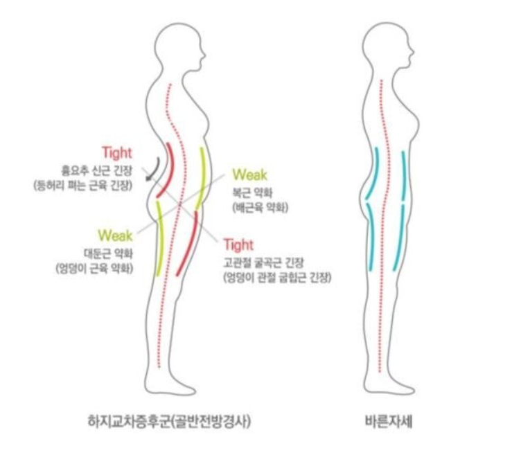 Characteristics of people with broken core muscles