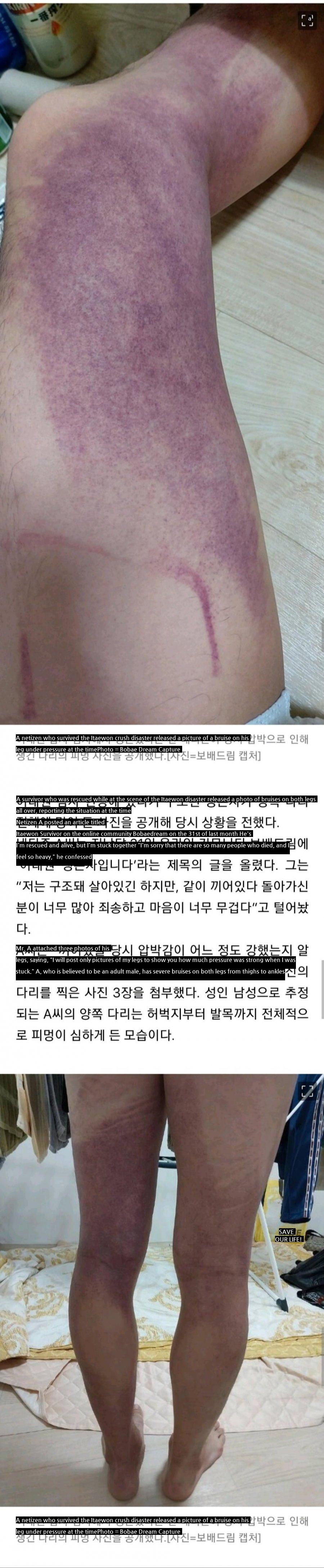 Itaewon disaster survivor's leg photo released.jpg