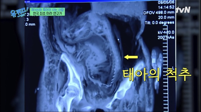 The mummy of Papyeong Yoon's pregnant woman