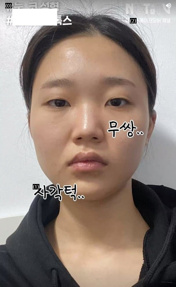 a pre- and post-op photo of a prosthetic woman