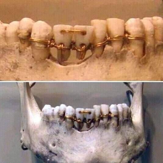 Dental work found in a 4,000-year-old mummy.jpg
