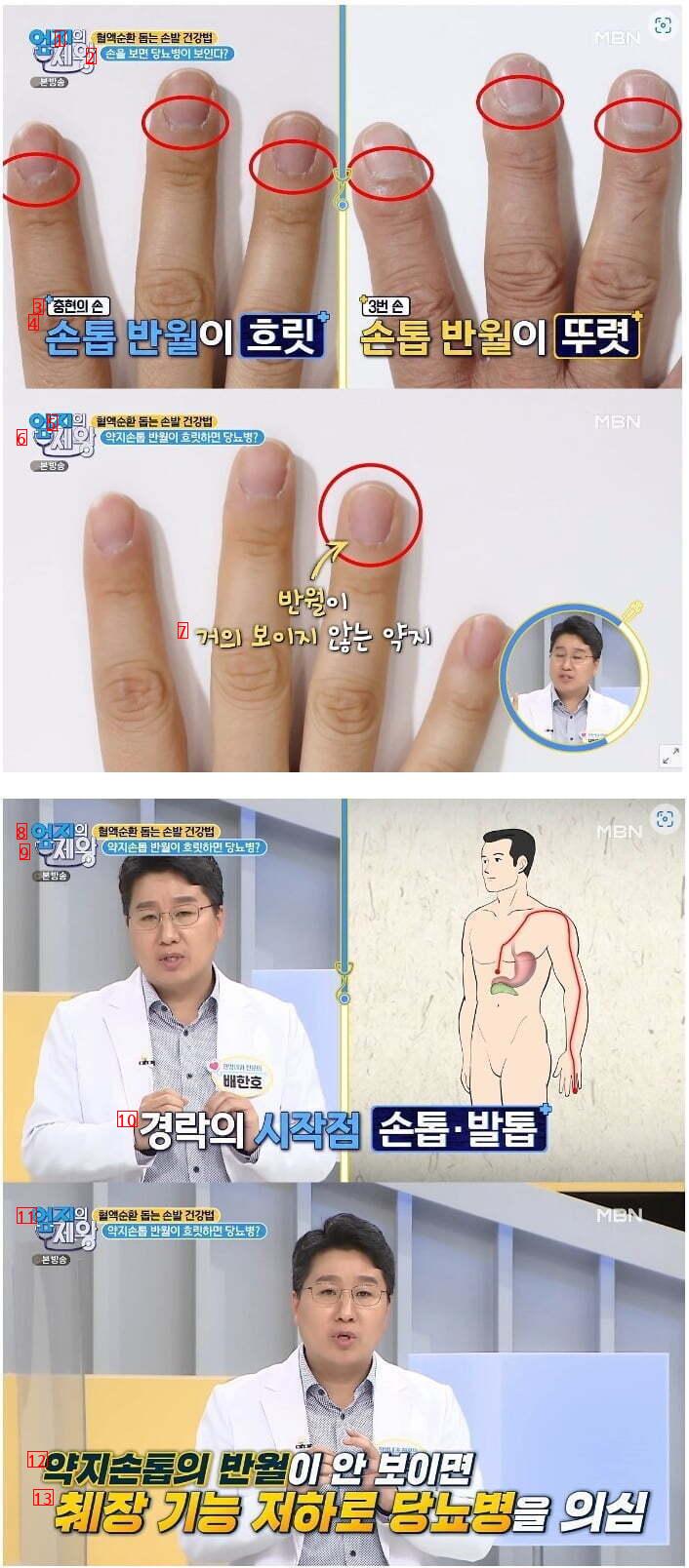 Diagnostic method of diabetes with fingernails jpg