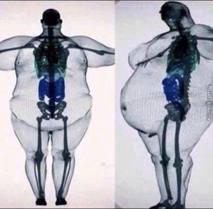 X-ray jpg of a highly obese person