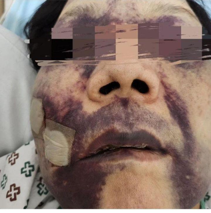 Please help me with the medicine My mother was assaulted without asking