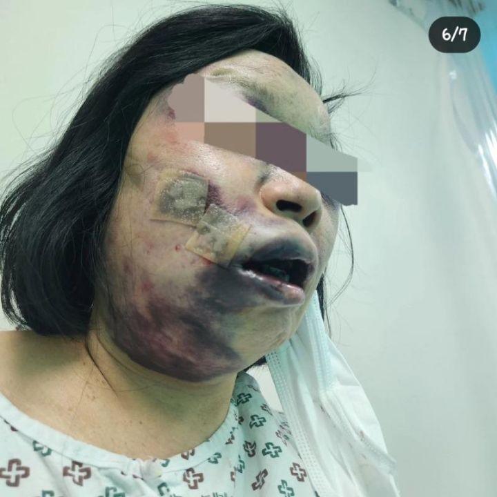 Please help me with the medicine My mother was assaulted without asking