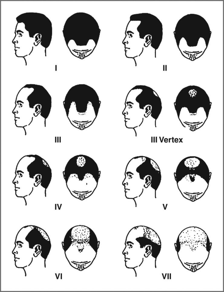 The 5 stages of hair loss spread and death