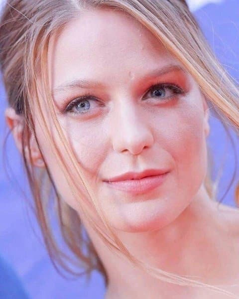 Actress Melissa Benoist became an acquired odd-eye