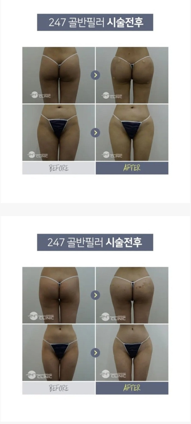 There is also pelvic plastic surgery.